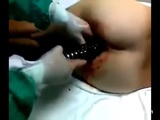 Shock Absorber Surgically Removed From Ass - Shock absorber Videos