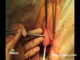 Bloody Pussy Surgery - Surgery Videos